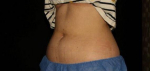 Coolsculpting - Case #11 Before